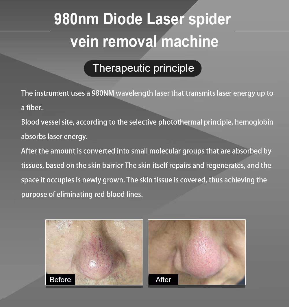 980nm Diode Laser Red Blood Spider Vein Removal Vascular Removal Machine
