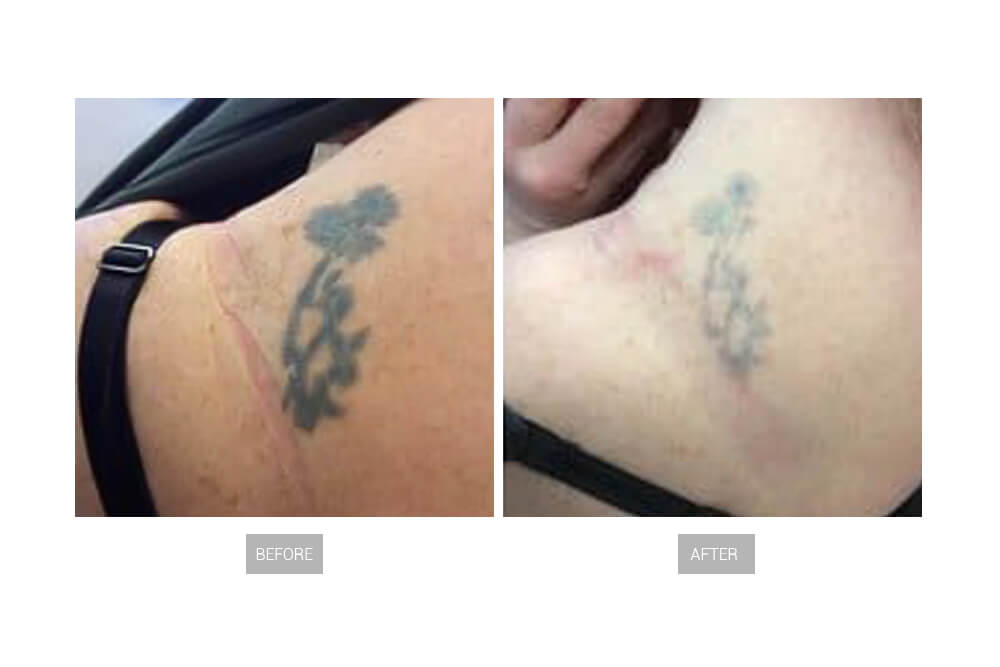 tattoo-removal-before-and-after-7