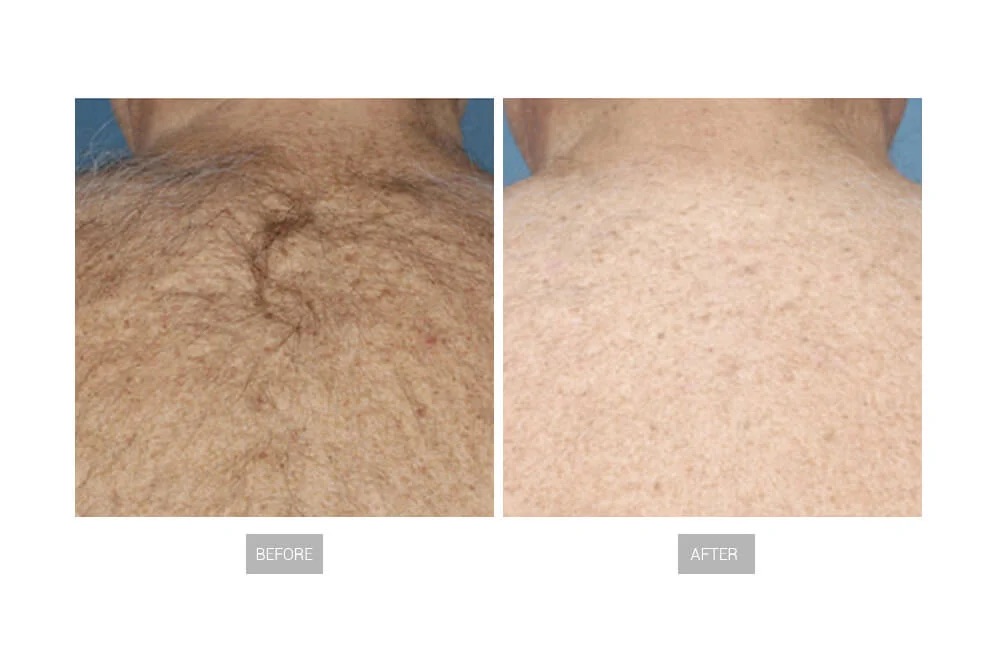 hair-removal-before-and-after-6