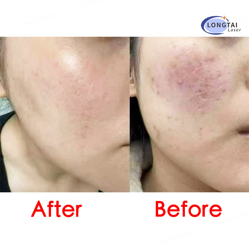 INUS Vacuum Fractional Micro Needle RF – For Wrinkles, Acne Scars, Lifting & Pores