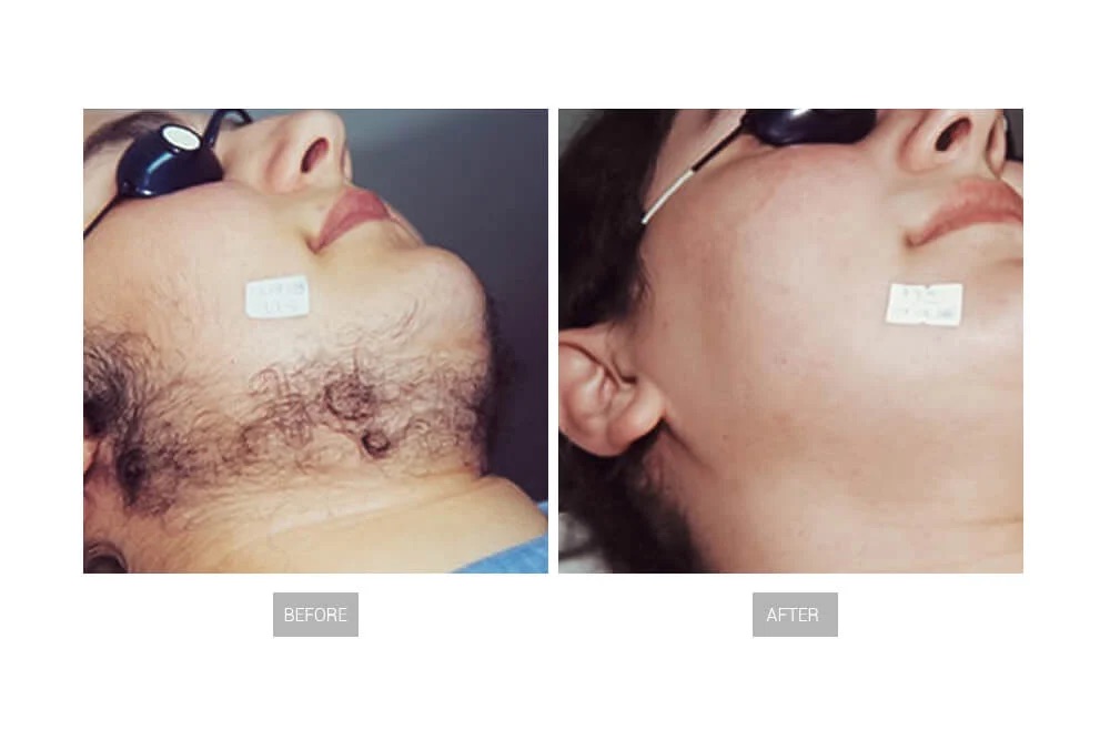 hair-removal-before-and-after-2