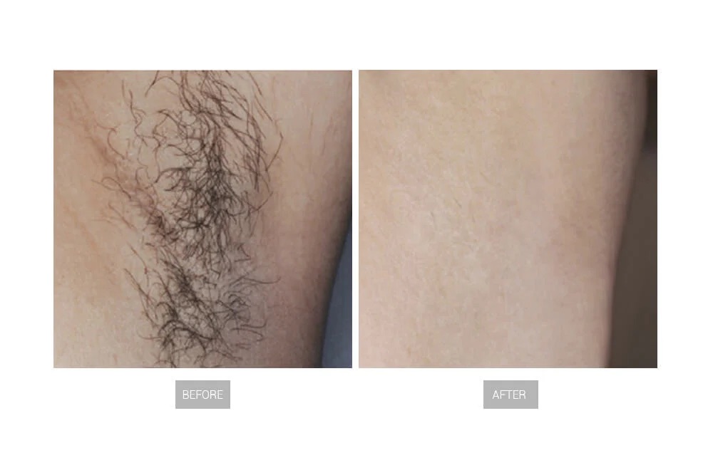 hair-removal-before-and-after-7