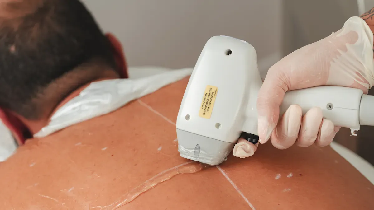 Hair Removal Lasers